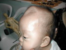Epilepsy Cure in Acupuncture Herbal Treatment